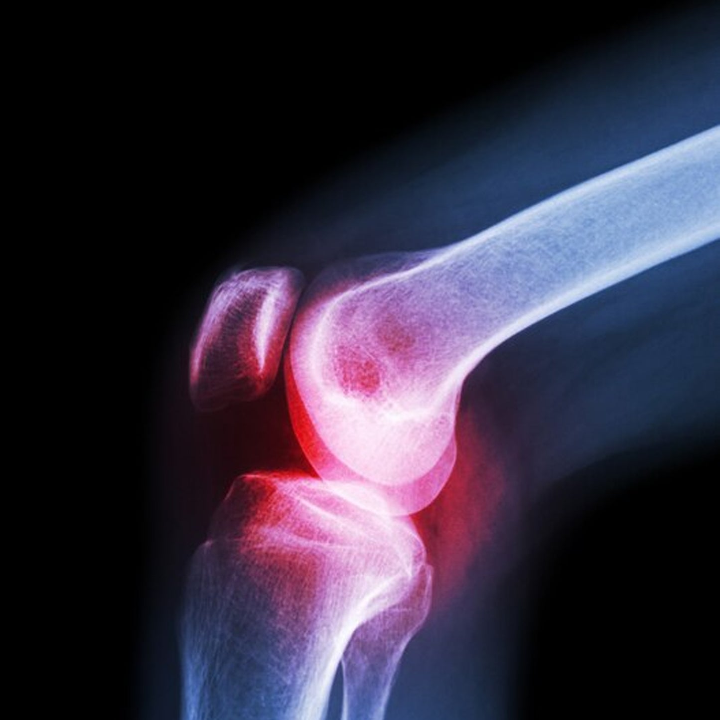 MKK-44 (Xl) Knee Cap For Knee Support